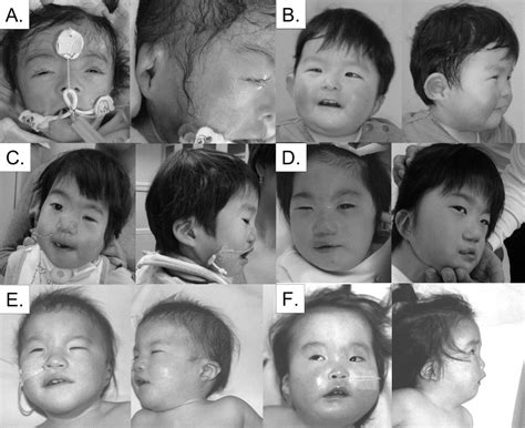 Phenotypic Spectrum Of Charge Syndrome With Chd7 Mutations The