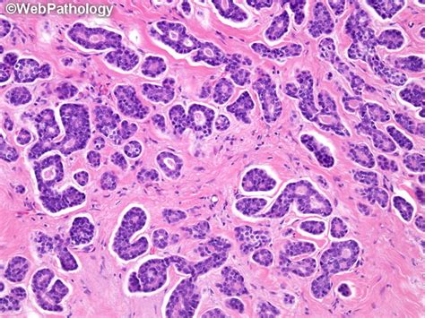 Webpathology Com A Collection Of Surgical Pathology Images