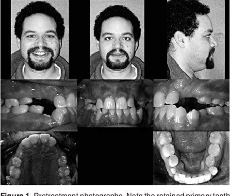 Figure 1 From Treatment Of A Patient With Multiple Impacted Teeth