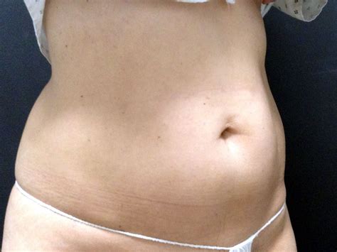before and after coolsculpting — cpw vein and aesthetic center