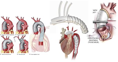 Surgery Of The Aorta Aortic Root Ascending And Arch Of The Aorta