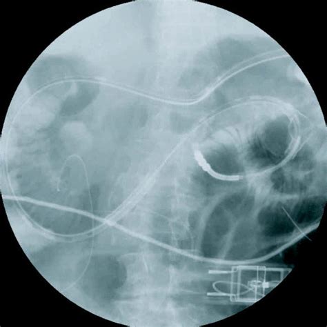Abdominal Radiograph Demonstrating Percutaneous Gastrojejunostomy Tube