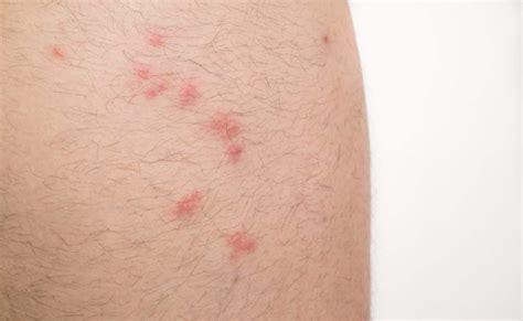 Flea Bites On Humans Pictures And Tips Nextgen Pest Solutions