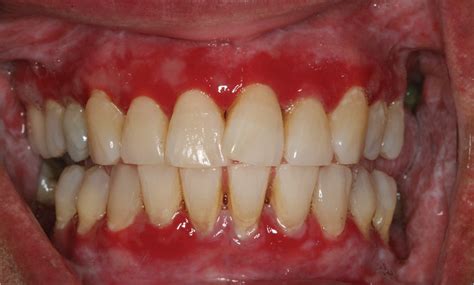 Recurrent Gingival And Oral Mucosal Lesions Dental Medicine Jama