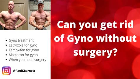 can you get rid of gyno gynocamastia without surgery youtube