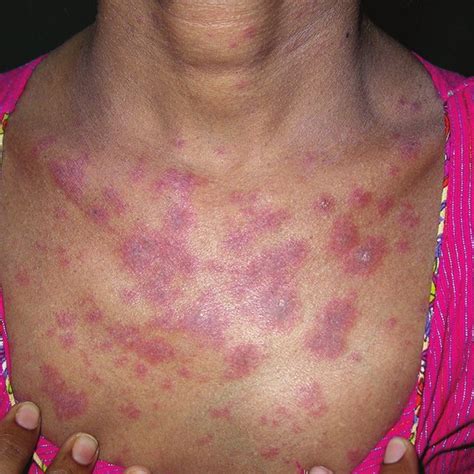 A Extensive Erythema Multiforme Lesions Over Face Trunk Abdomen