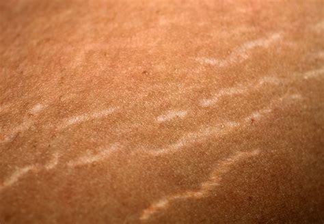 What You Should Know About Stretch Marks On The Breasts Cleveland Clinic