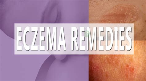 5 Remedies For Eczema Top Natural Remedy