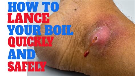 Lancing A Boil How To Actually Lance A Boil Pop Cyst Infectious