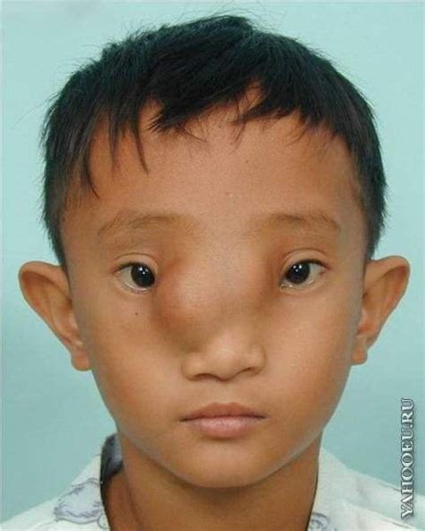 People With Rare Facial Deformities
