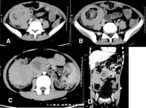 Primary Lymphoma Of The Colon Report Of Two Cases And Review Of