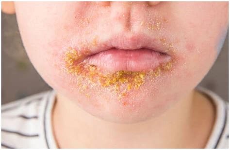 Impetigo Vs Herpes Differences And Treatment Your Health Remedy