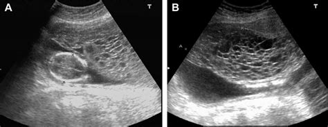 Placenta Accreta Fetal Ultrasound