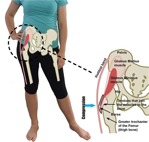 Anatomy it band pelvis muscle pelvis with muscles hip muscles muscles of pelvis tensor fascia latae psoas major anatomy pelvis tensor fascia lata pelvis muscles. Gluteal Tendinopathy, Trochanteric/Hip Bursitis, & Greater ...