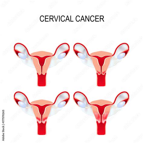 cervical cancer staging carcinoma of cervix stock vector adobe stock