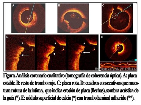 TomografÍa De Coherencia Óptica Oct El Futuro Ha Llegado