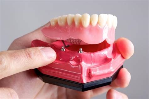 The Difference Between Implant Dentures And Implant Overdentures