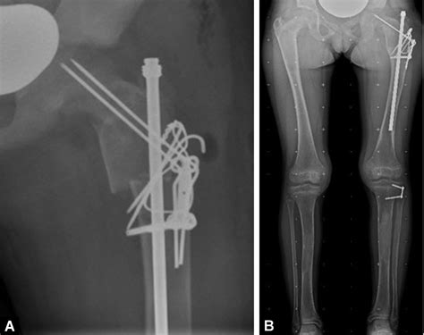 Deformity Correction Surgical Stabilisation And Limb Length