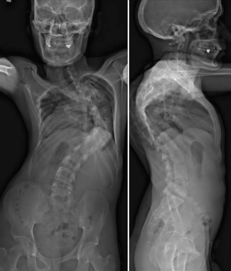 Scoliosis X Ray X Rays Pinterest Photos Scoliosis And X Rays My XXX