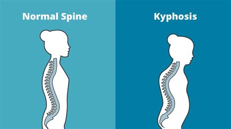 Is Kyphosis A Disability What Are Its Symptoms And Causes