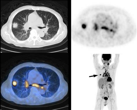Petct Scan Shows One Subpleural Nodule At The Right Middle Lobe With