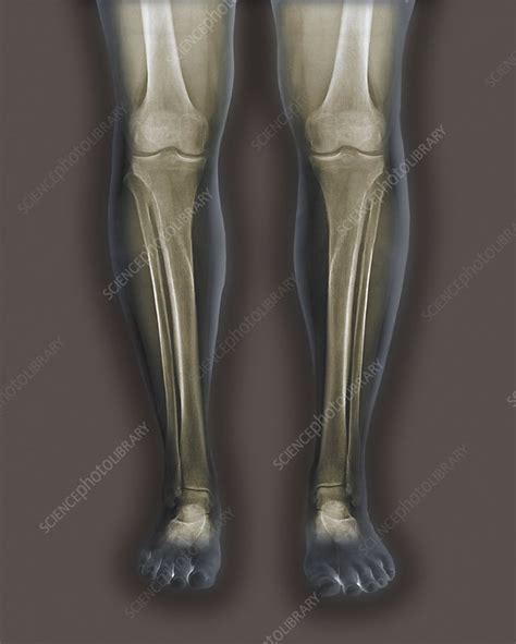 Normal Legs X Rays Stock Image C0155090 Science Photo Library