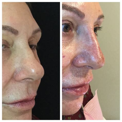 Beforeafter Botox Filler Kybella Laser Skin Care Augusta Ga