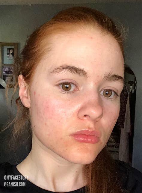 Why Showing Off Your Acne On Instagram Is The Hot New Trend You Want T