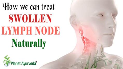 Swollen Lymph Nodes In Neck Causes And Treatment Vrogue Co