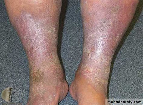 Eczema Dermatitis And Lichenification Pptx دمحمد شحاذه Muhadharaty