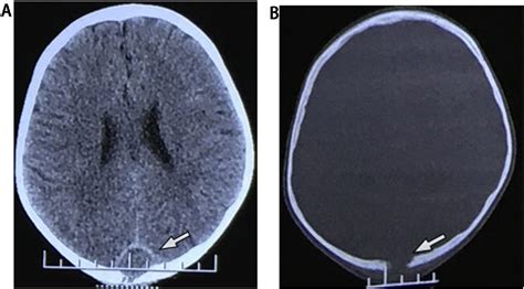 Figure 1 From Infected Intradural Dermoid Cyst Without Dermal Sinus