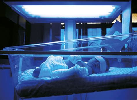 Neonatal Jaundice Controlling Bilirubin Therapy Lighting