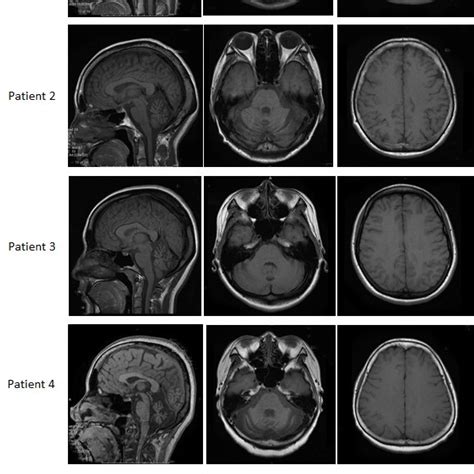 T1 Weighted Mri Images Of The Patients Download Scientific Diagram