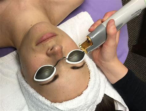 Timeless Medical Spa Advanced Esthetics Lasers Injectables Cutera