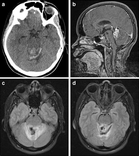 Preoperative Imaging Shows Cerebellar Bleeding In The Vermis And 4th