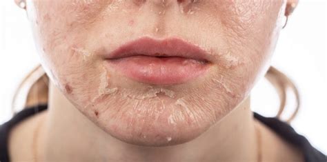 How To Get Rid Of Peeling Skin On The Face
