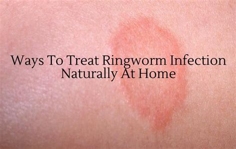 Ringworm Is A Skin Infection Not Caused By A Worm As It May Seem But