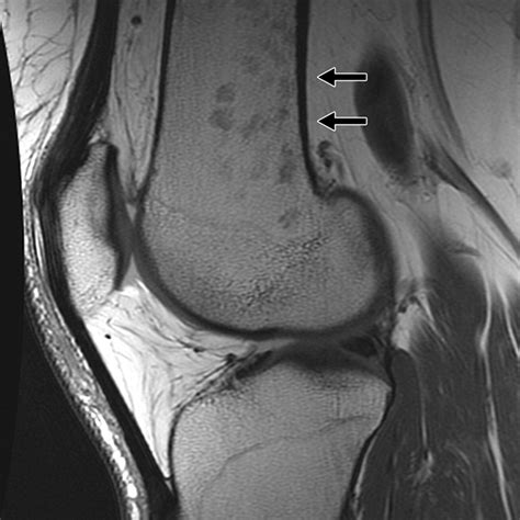 Bone Marrow Signal Alteration In The Extremities Ajr