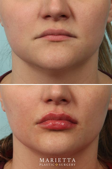Before And After Juvederm Lip Filler In 2021 Lip Fillers Lip Fillers