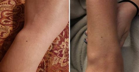 Women Are Sharing Pictures Of The Identical Freckle They All Have On Their Wrist Metro News