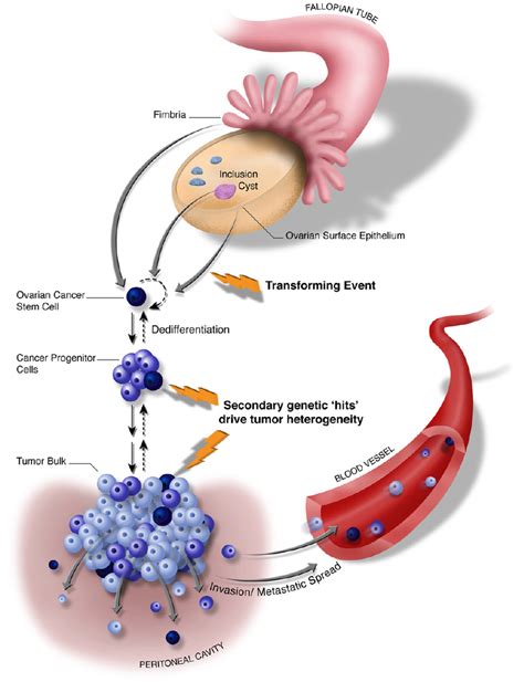 Ovarian Cancer Pathophysiology Diagram