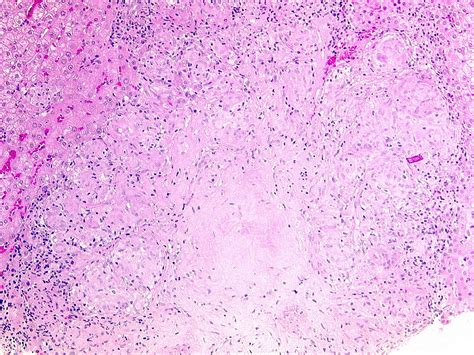 Pathology Outlines Granulomatous Hepatitis Noninfectious