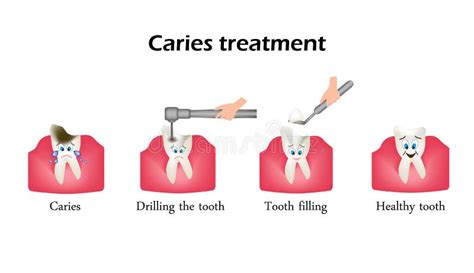 Treatment Of Caries Sealing Of The Tooth Infographics Stock Vector