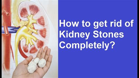 Complete Removal Of Kidney Stones Pcnl Or Keyhole Treatment Dr