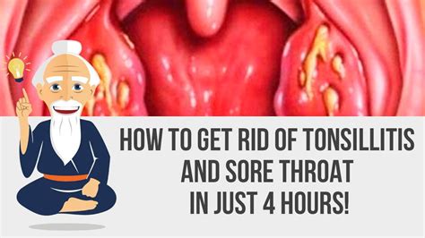 How To Get Rid Of Tonsillitis And Sore Throat In Only Four Hours With