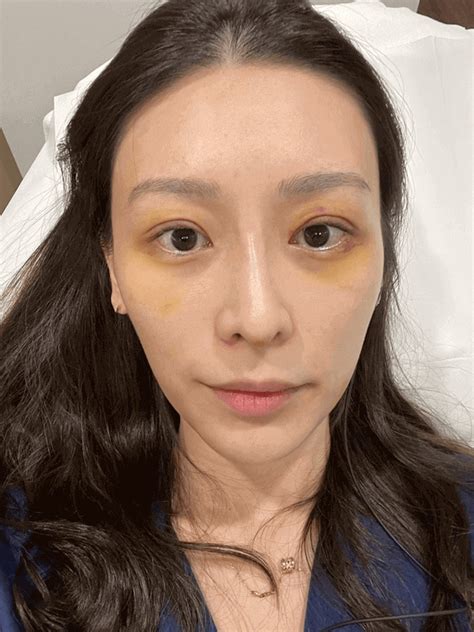My Double Eyelid Surgery Review And Results Grace Chua