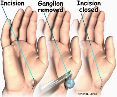 Tom S Physiotherapy Blog Fingers Ganglion Cysts