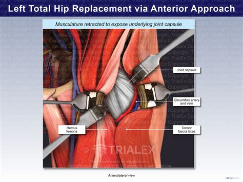 Left Total Hip Replacement Via Anterior Approach Trial Exhibits