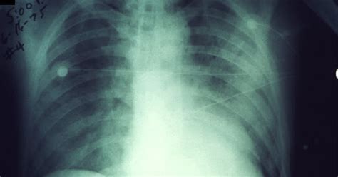 Simptom pnuemonia termasuk batuk, berkahak, demam, rasa letih dan sesak nafas. Jangkitan Paru paru: Punca, Simptom dan Rawatan - The Diagnosa