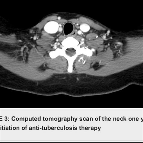 Computed Tomography Scan Of The Neck With Supraclavicular Mass